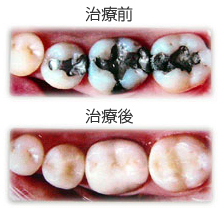 白い被せ物・詰め物