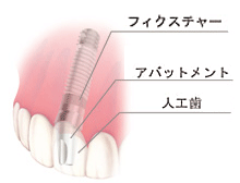 インプラント