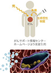 光殺菌治療