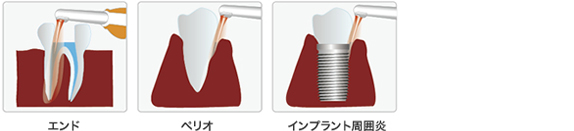 エンド　ぺリオ　インプラント歯周炎