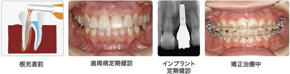 根充直前　歯周病定期健診　インプラント定期健診　矯正治療中